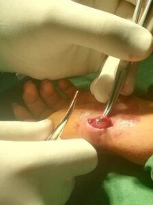higrom ganglion operacija