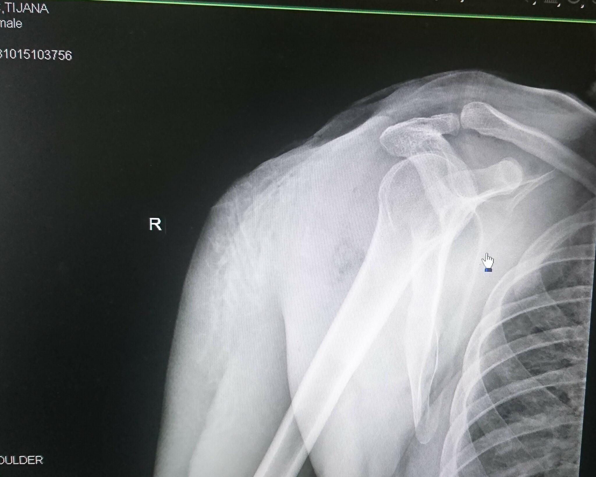 Kalcifikat ramena - Kalcifikacije ramena - Burzitis ramena - Dr Dren