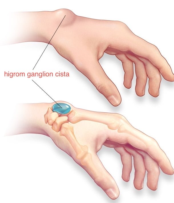 higrom hygroma ganglion cista